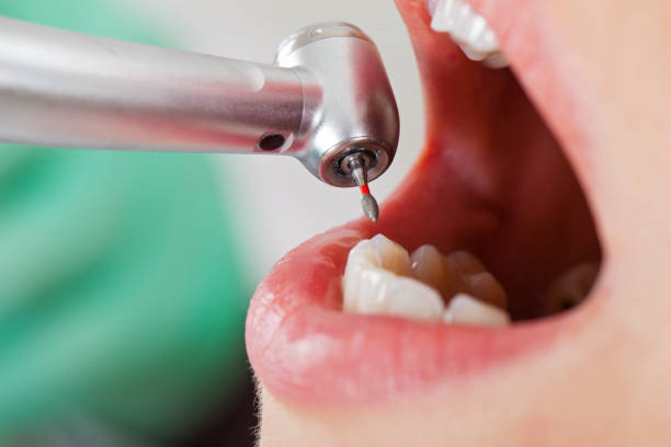 Best Emergency Tooth Extraction in Beaumont, TX